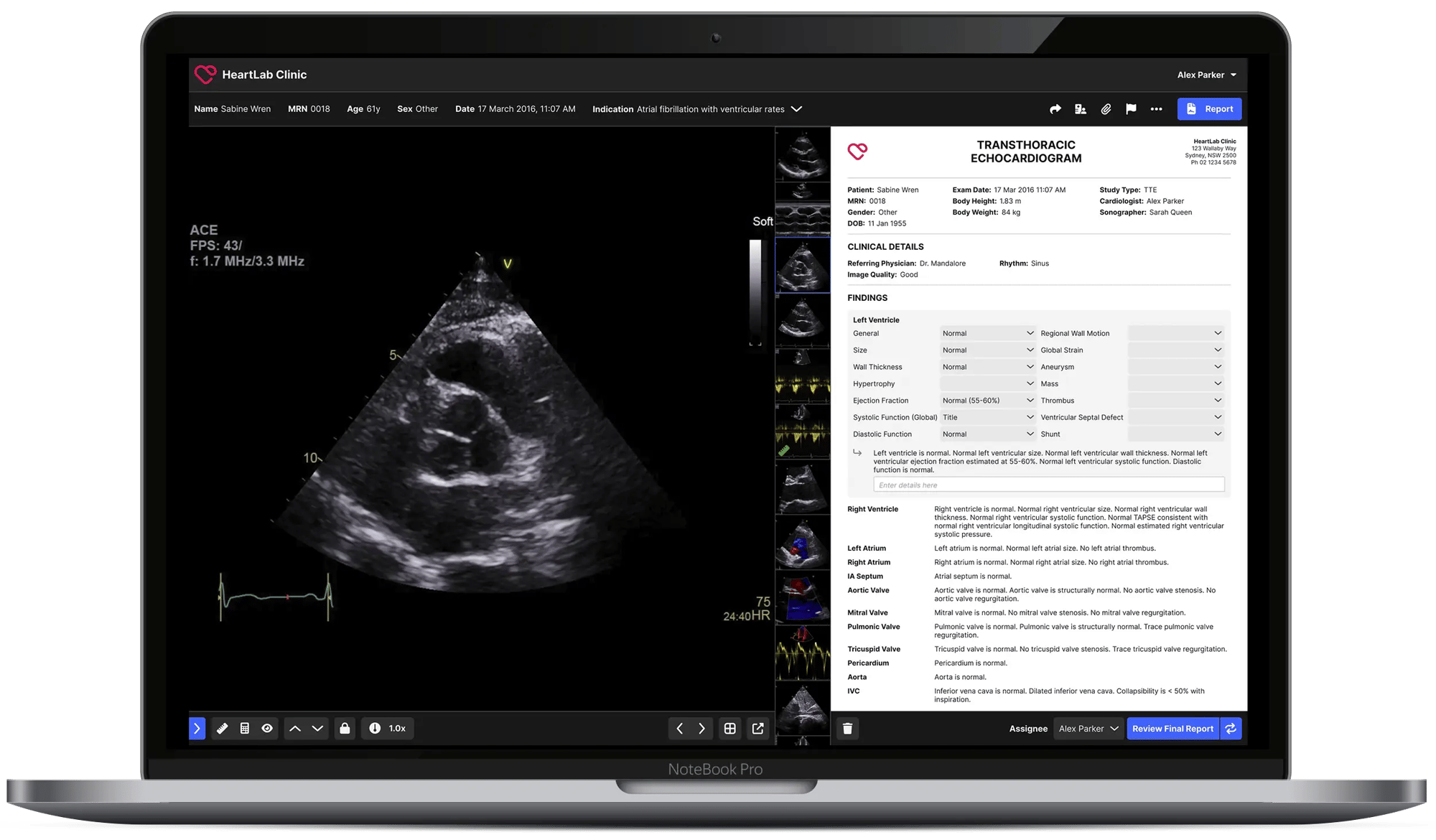 Laptop screen showing HeartLab Clinic Echocardiogram